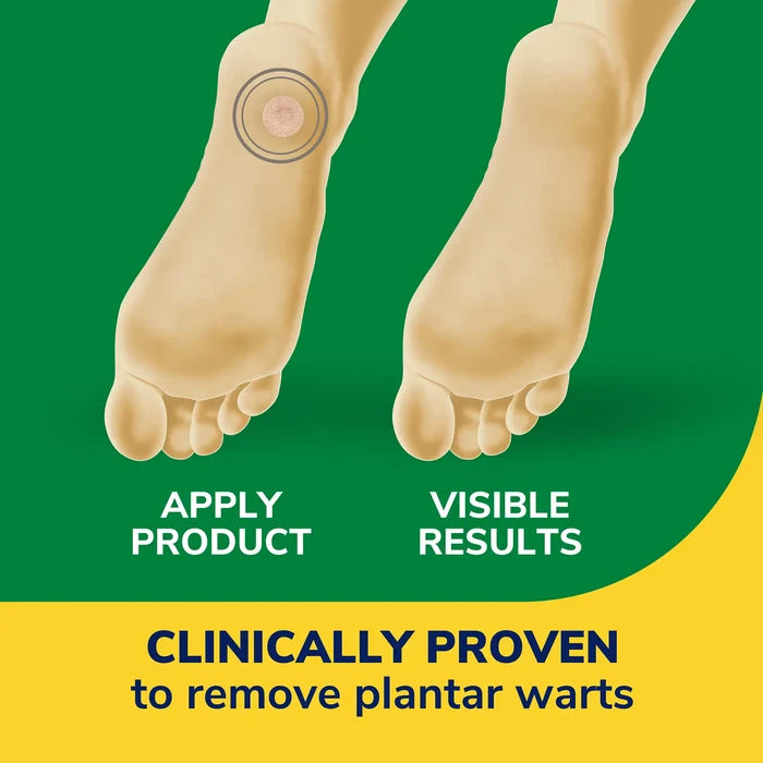 Plantar wart remover instructions graphic with foot and circular disc on skin
