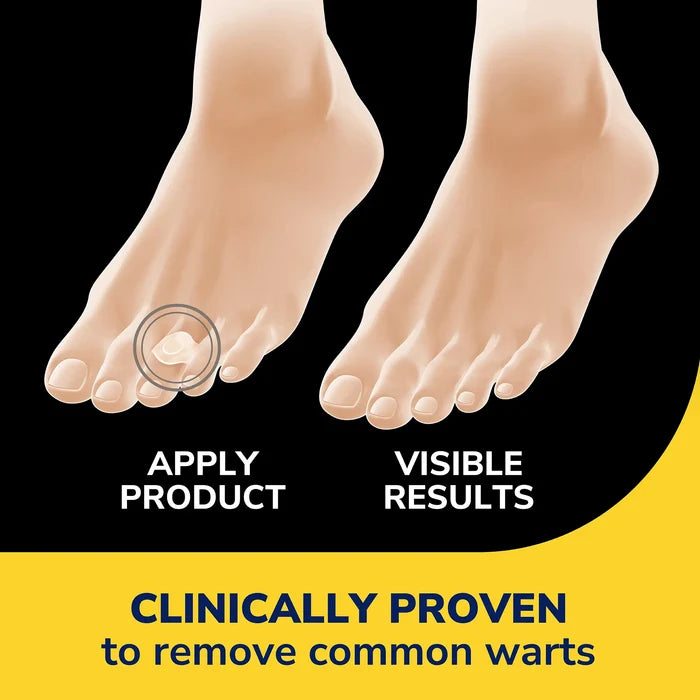 Wart remover hydrogel bandage disc applied on toes, showing visible results