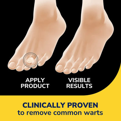 Wart remover hydrogel bandage disc applied on toes, showing visible results