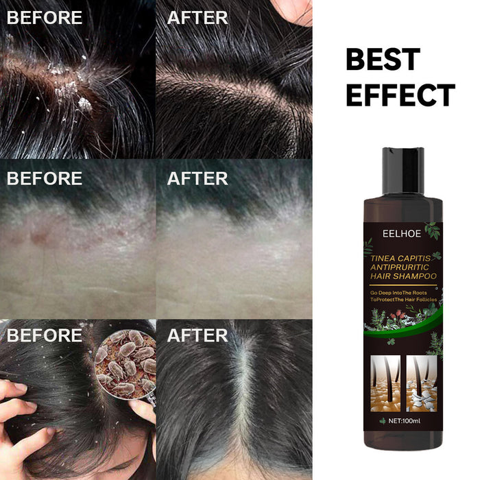 EELHOE Anti Dandruff Shampoos & Stop Itching EELHOE COSMETICS