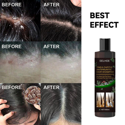 EELHOE Anti Dandruff Shampoos & Stop Itching EELHOE COSMETICS