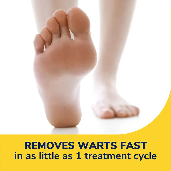 Bare foot for wart treatment, toes and arch visible
