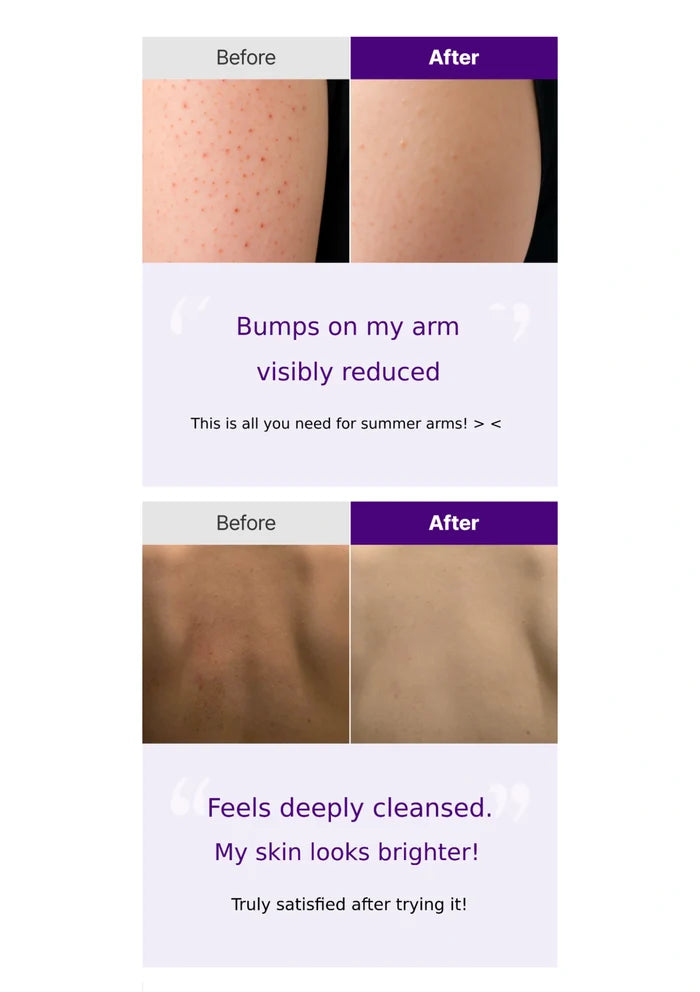 Before and after comparison of skin treatment on arms with text indicating reduced bumps and improved skin appearance.