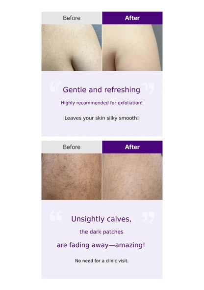 Before and after skin treatment results with a focus on calve dark patches fading away.