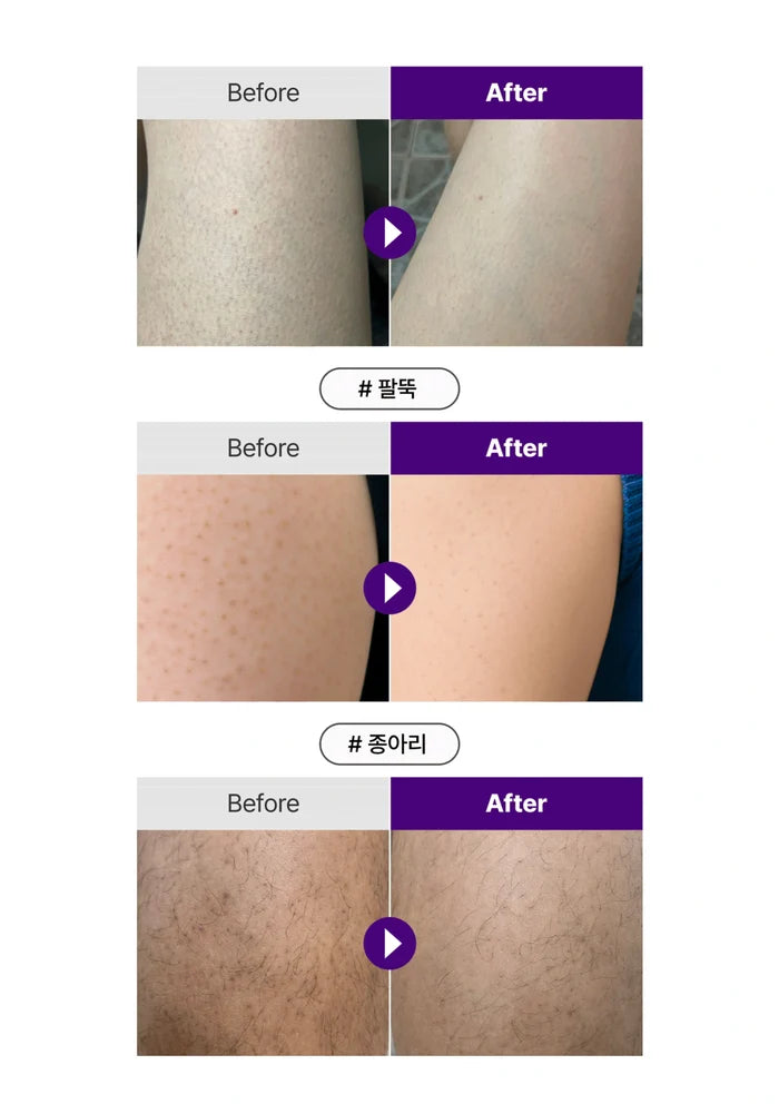 Before and after skin treatment comparison with visible changes on skin surface.